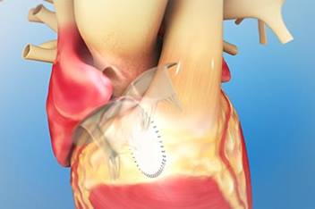 Heart Animation Teaser