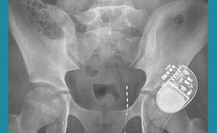 Pediatric Fecal and Urinary Incontinence